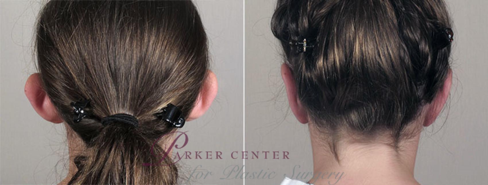 Ear Surgery Case 244 Before & After View #1 | Paramus, NJ | Parker Center for Plastic Surgery