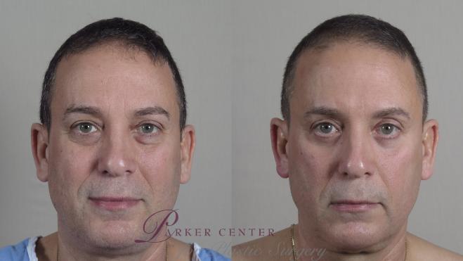 Eyelid Lift Case 1017 Before & After Front | Paramus, NJ | Parker Center for Plastic Surgery