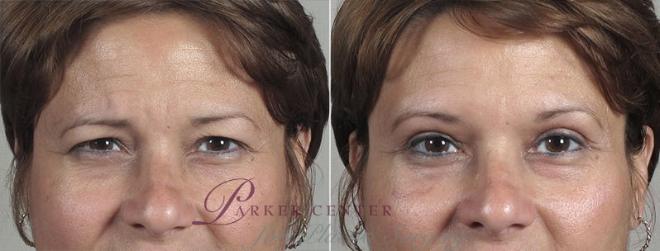 Eyelid Lift Case 107 Before & After View #1 | Paramus, NJ | Parker Center for Plastic Surgery