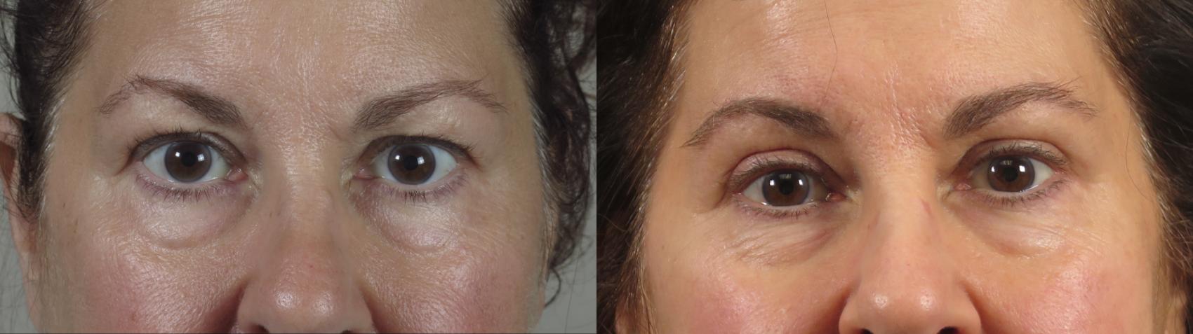 Eyelid Lift Case 1564 Before & After Left Side | Paramus, New Jersey | Parker Center for Plastic Surgery