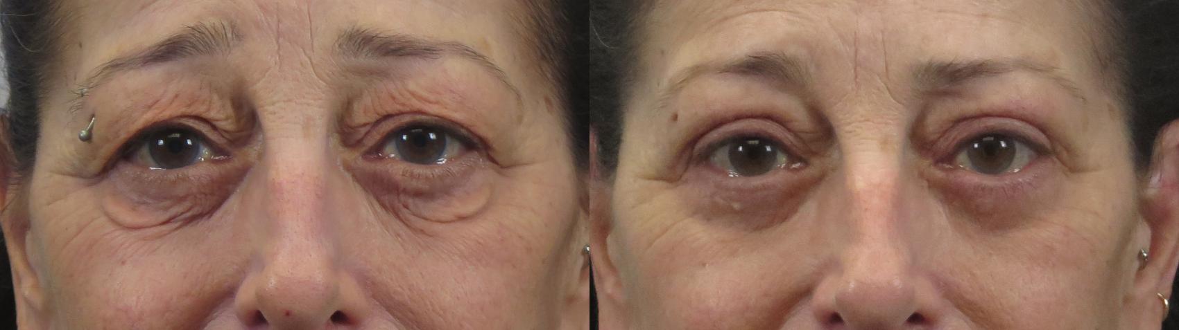 Eyelid Lift Case 1598 Before & After Front | Paramus, New Jersey | Parker Center for Plastic Surgery