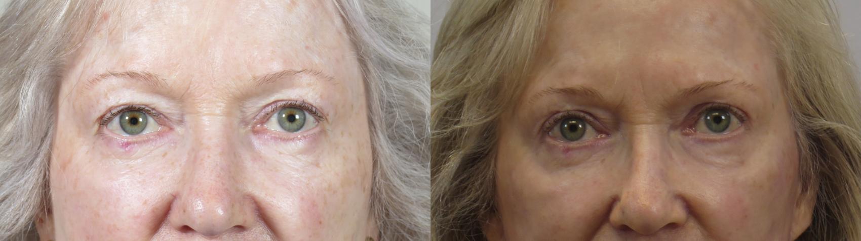 Eyelid Lift Case 1619 Before & After Front | Paramus, New Jersey | Parker Center for Plastic Surgery
