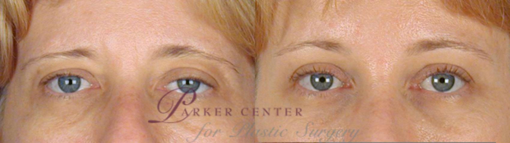 Eyelid Lift Case 56 Before & After View #1 | Paramus, NJ | Parker Center for Plastic Surgery
