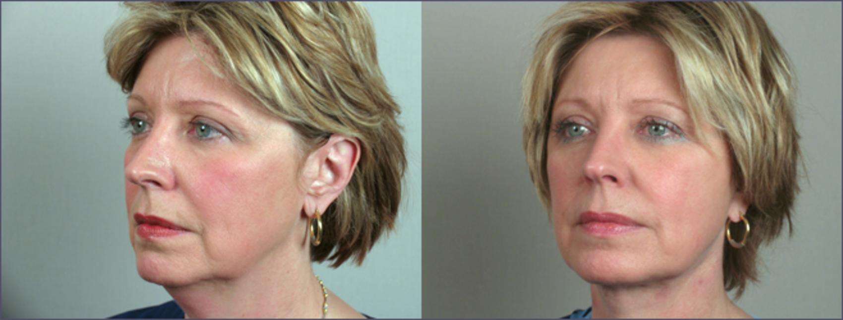 Eyelid Lift Case 63 Before & After View #1 | Paramus, NJ | Parker Center for Plastic Surgery