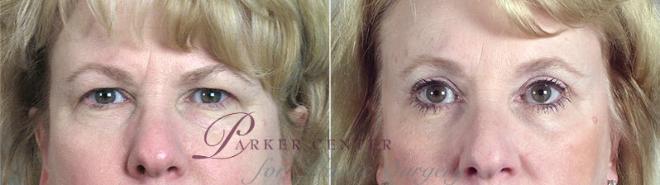 Eyelid Lift Case 66 Before & After View #1 | Paramus, NJ | Parker Center for Plastic Surgery