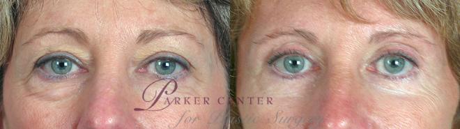 Eyelid Lift Case 68 Before & After View #1 | Paramus, NJ | Parker Center for Plastic Surgery