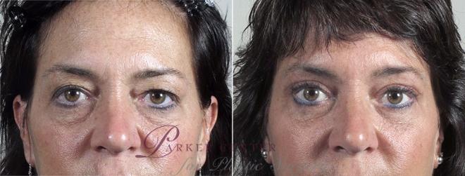 Eyelid Lift Case 96 Before & After View #1 | Paramus, NJ | Parker Center for Plastic Surgery