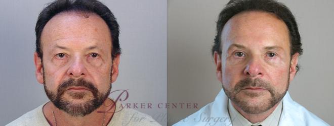 Eyelid Lift Case 14 Before & After View #1 | Paramus, NJ | Parker Center for Plastic Surgery