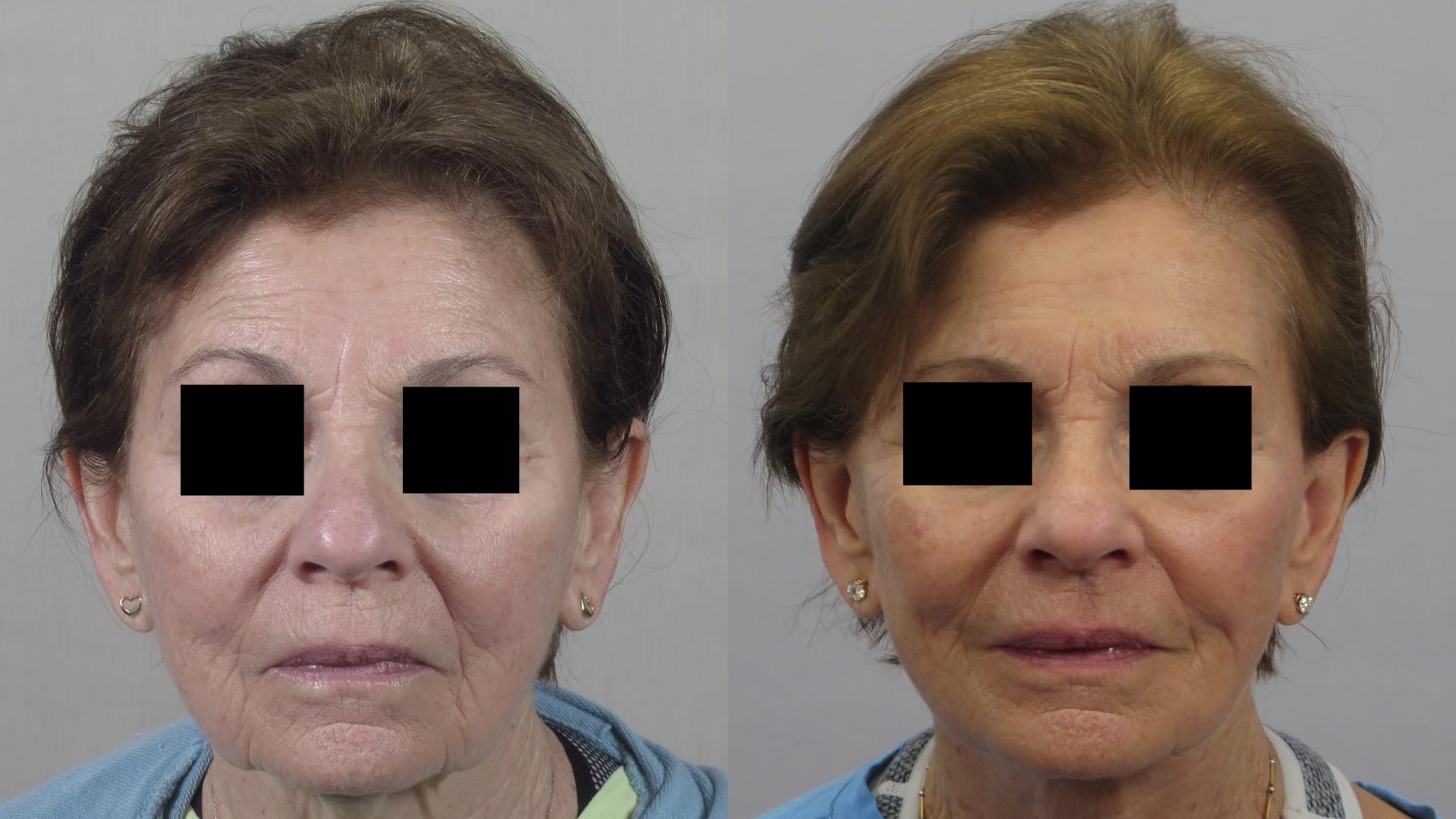 Facelift Case 1580 Before & After Front | Paramus, New Jersey | Parker Center for Plastic Surgery