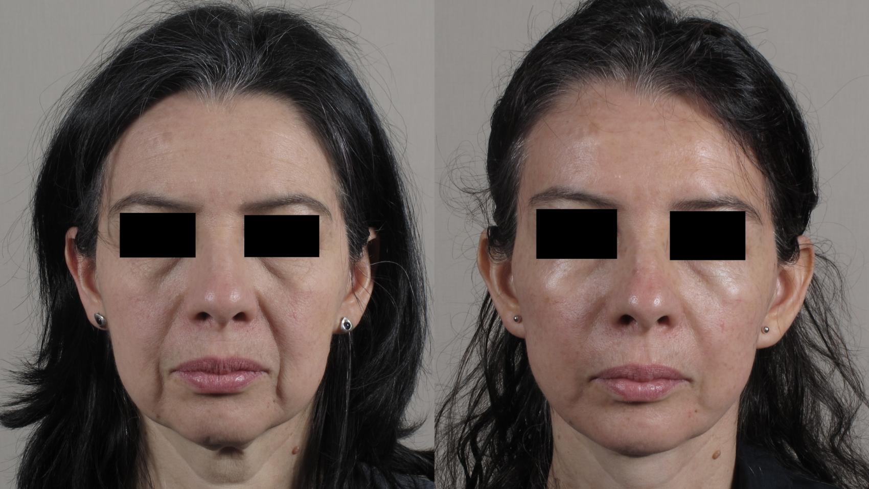 Facelift Case 1582 Before & After front 1 | Paramus, New Jersey | Parker Center for Plastic Surgery