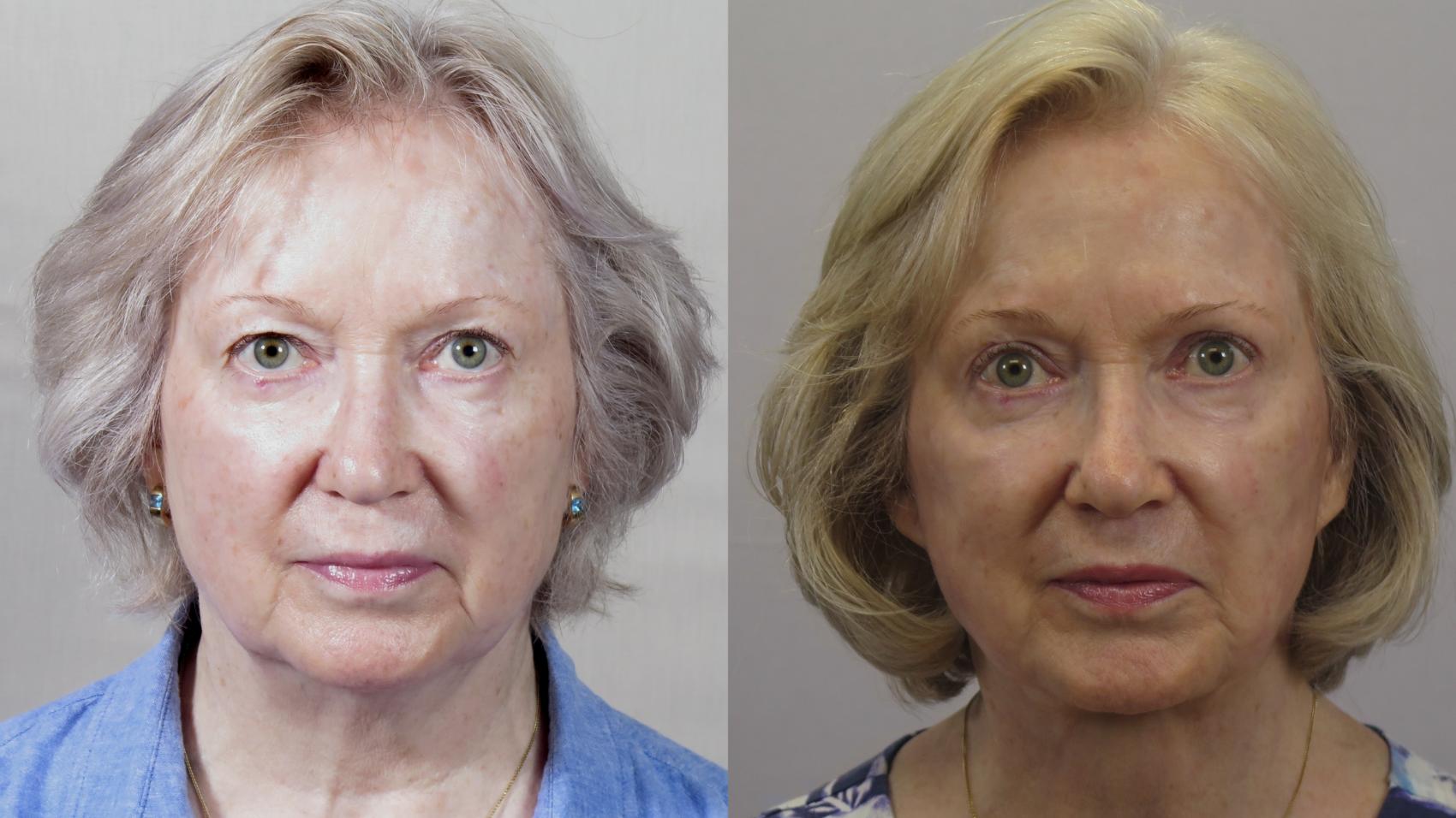 Facelift Case 1620 Before & After Front | Paramus, New Jersey | Parker Center for Plastic Surgery