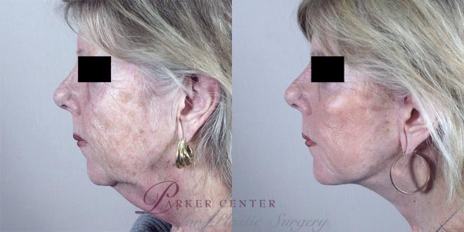 Facelift Case 18 Before & After View #1 | Paramus, NJ | Parker Center for Plastic Surgery