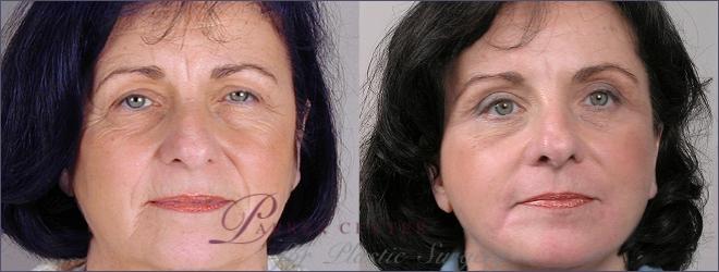 Facelift Case 3 Before & After View #1 | Paramus, NJ | Parker Center for Plastic Surgery