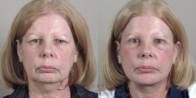 Facelift Case 38 Before & After View #1 | Paramus, NJ | Parker Center for Plastic Surgery