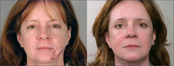 Facelift Case 4 Before & After View #1 | Paramus, NJ | Parker Center for Plastic Surgery