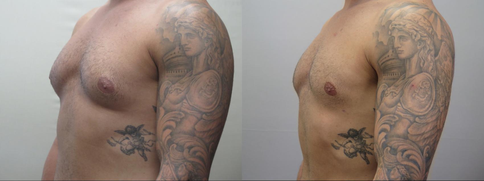 Gynecomastia Surgery Case 1563 Before & After Left Oblique | Paramus, New Jersey | Parker Center for Plastic Surgery
