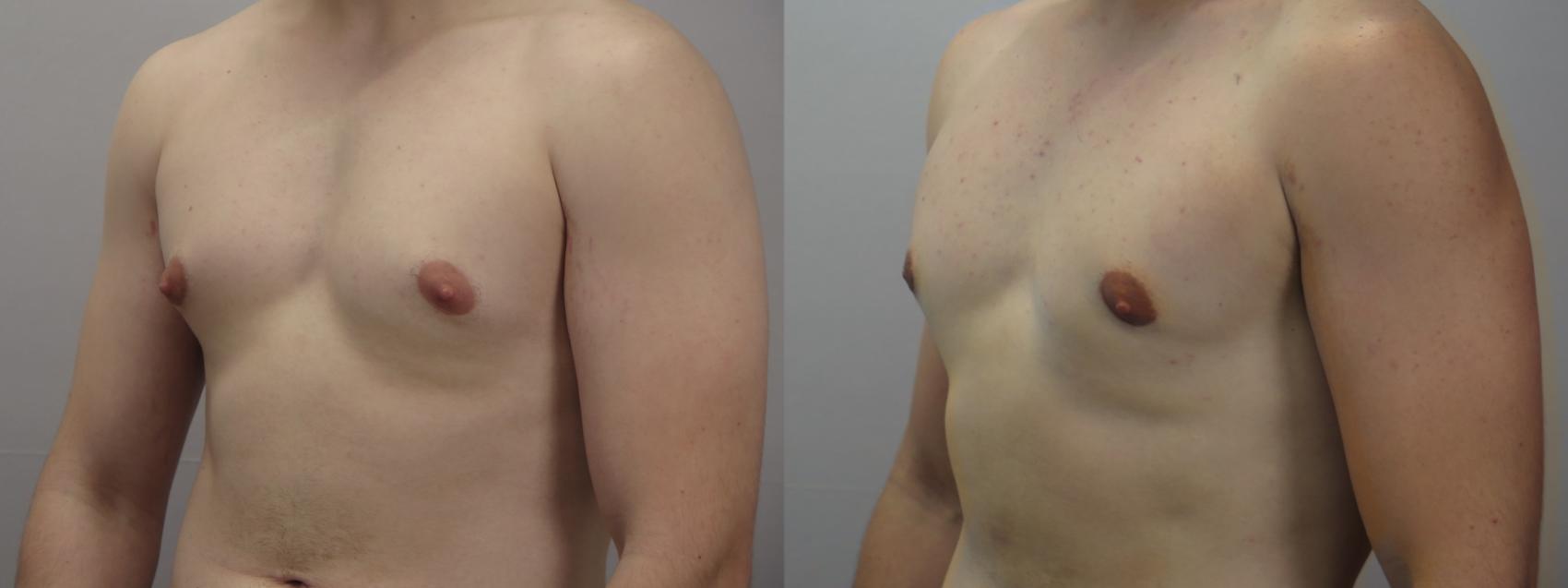 Gynecomastia Surgery Case 1623 Before & After Left Oblique | Paramus, New Jersey | Parker Center for Plastic Surgery