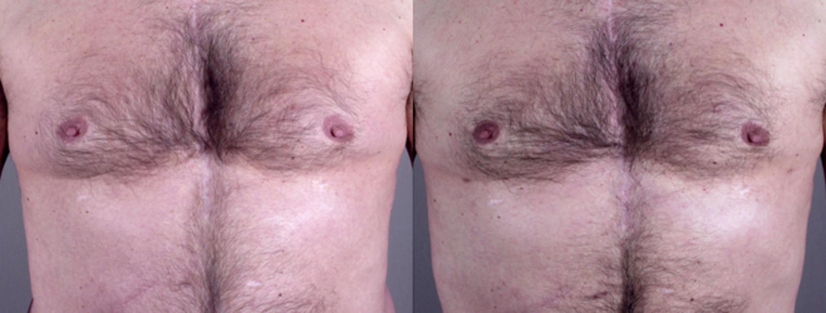 Gynecomastia Surgery Case 623 Before & After View #1 | Paramus, NJ | Parker Center for Plastic Surgery
