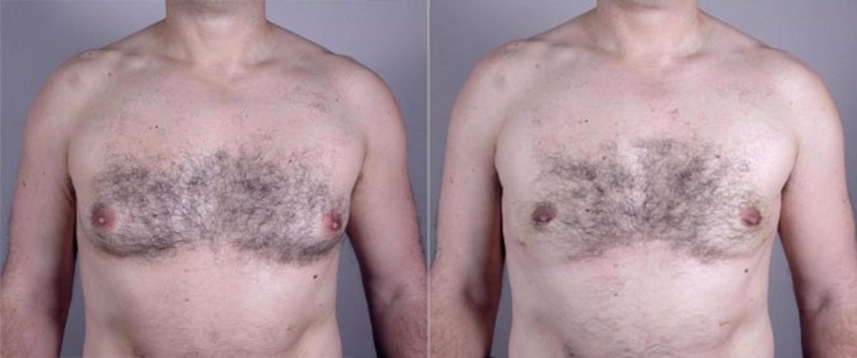Gynecomastia Surgery Case 624 Before & After View #1 | Paramus, NJ | Parker Center for Plastic Surgery