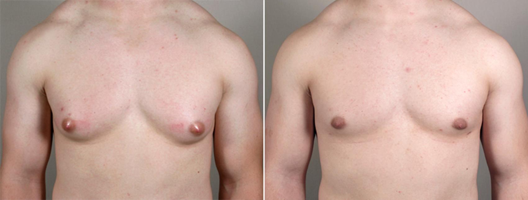 Gynecomastia Surgery Case 626 Before & After View #1 | Paramus, NJ | Parker Center for Plastic Surgery