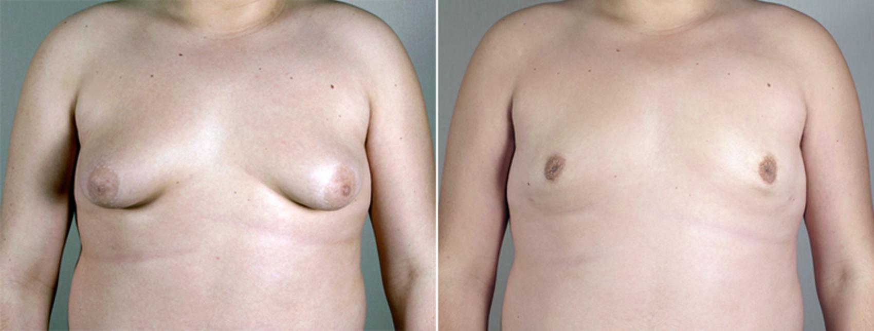 Gynecomastia Surgery Case 628 Before & After View #1 | Paramus, NJ | Parker Center for Plastic Surgery