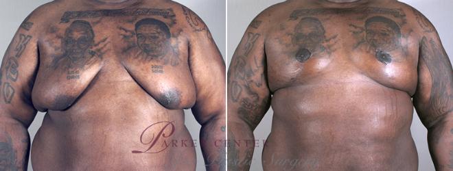 Gynecomastia Surgery Case 629 Before & After View #1 | Paramus, NJ | Parker Center for Plastic Surgery