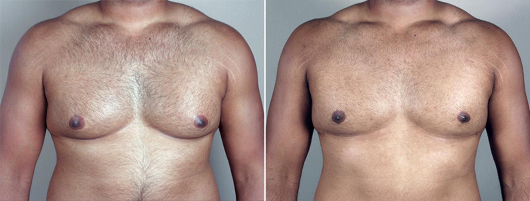 Gynecomastia Surgery Case 634 Before & After View #1 | Paramus, NJ | Parker Center for Plastic Surgery