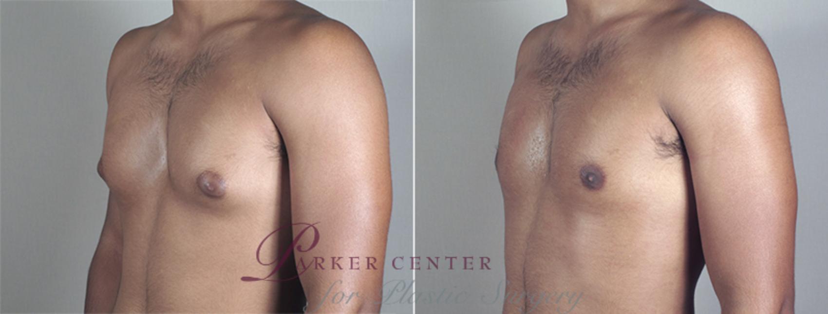 Gynecomastia Surgery Case 639 Before & After View #2 | Paramus, NJ | Parker Center for Plastic Surgery