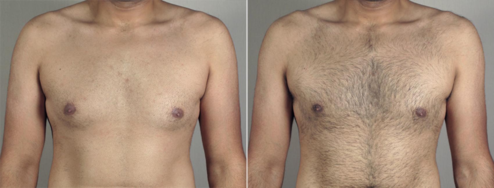 Gynecomastia Surgery Case 645 Before & After View #1 | Paramus, NJ | Parker Center for Plastic Surgery