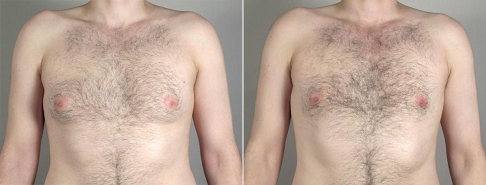Gynecomastia Surgery Case 646 Before & After View #1 | Paramus, NJ | Parker Center for Plastic Surgery
