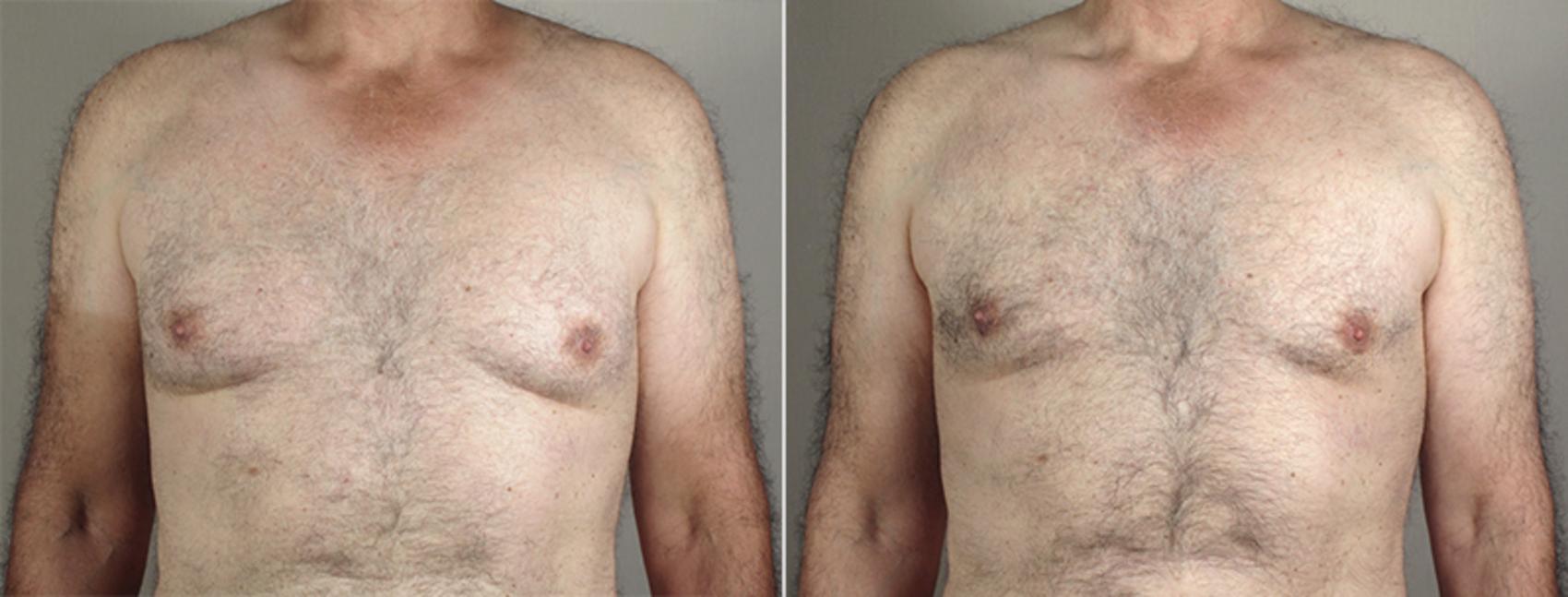 Gynecomastia Surgery Case 647 Before & After View #1 | Paramus, NJ | Parker Center for Plastic Surgery
