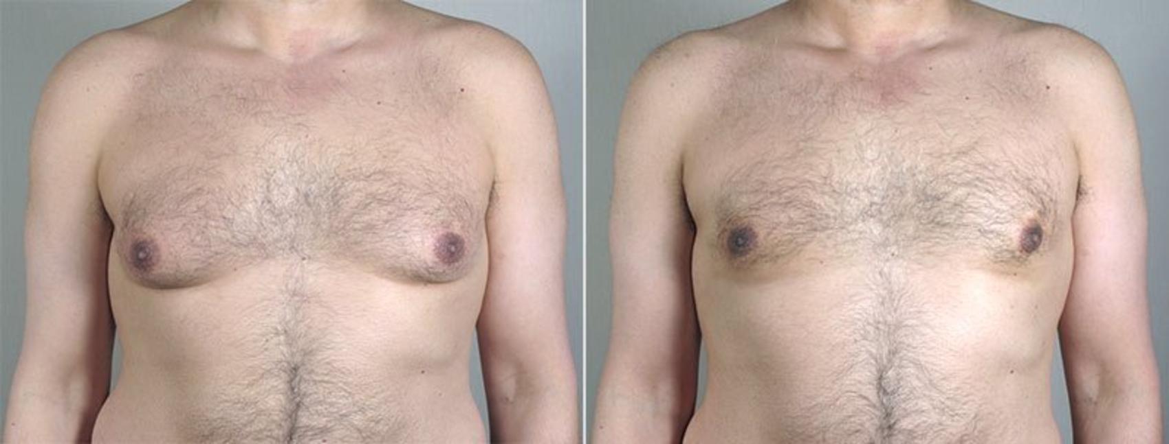 Gynecomastia Surgery Case 654 Before & After View #1 | Paramus, NJ | Parker Center for Plastic Surgery