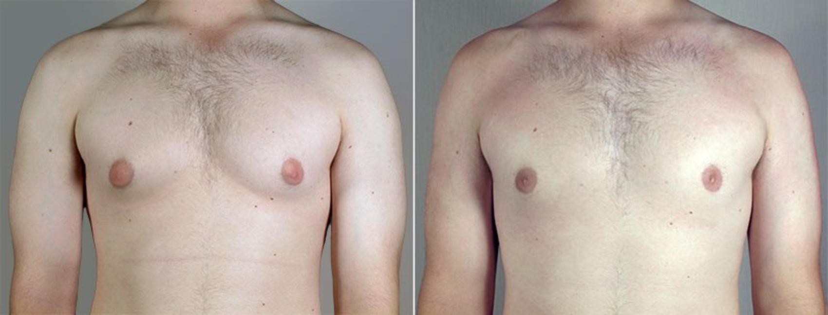 Gynecomastia Surgery Case 656 Before & After View #1 | Paramus, NJ | Parker Center for Plastic Surgery