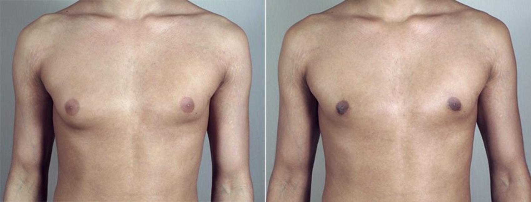Gynecomastia Surgery Case 657 Before & After View #1 | Paramus, NJ | Parker Center for Plastic Surgery