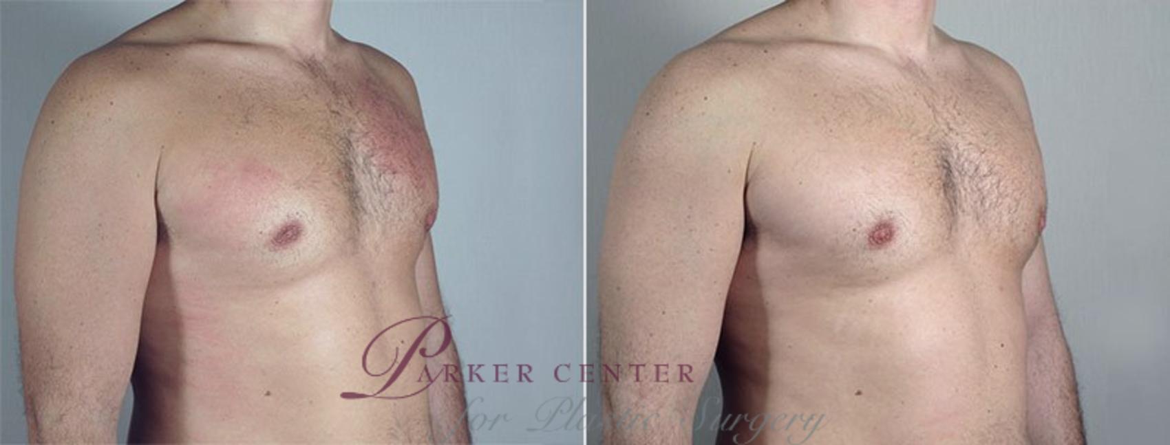Gynecomastia Surgery Case 661 Before & After View #1 | Paramus, NJ | Parker Center for Plastic Surgery