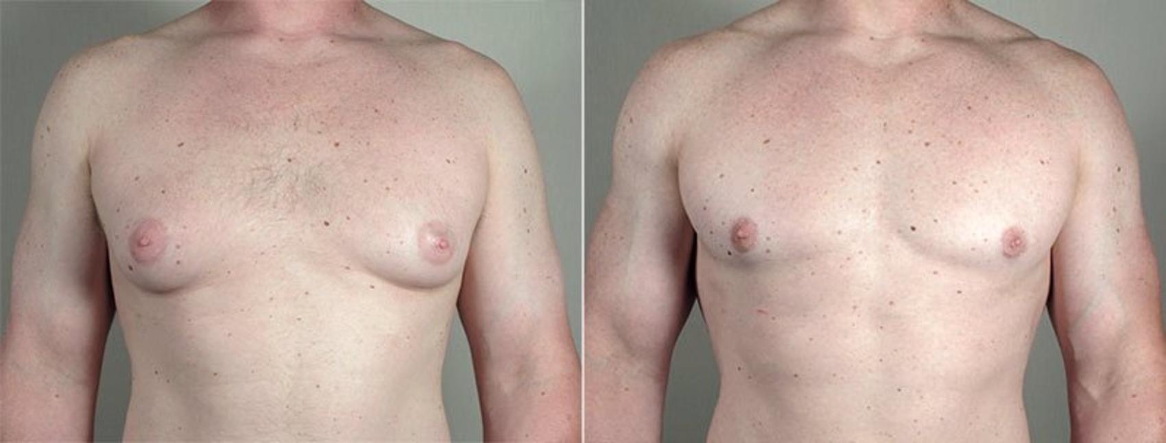 Gynecomastia Surgery Case 663 Before & After View #1 | Paramus, NJ | Parker Center for Plastic Surgery