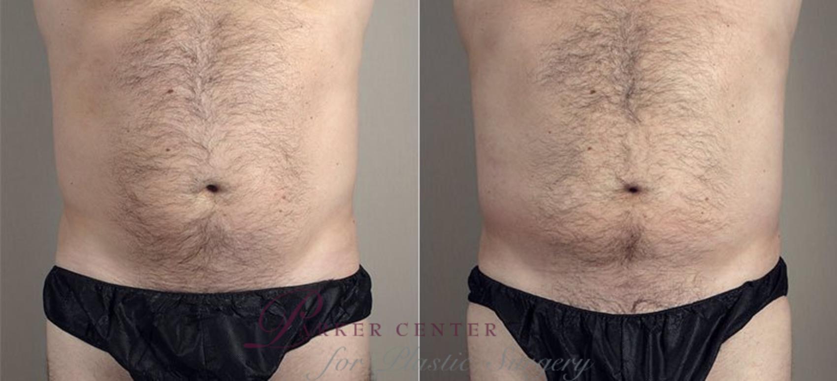 Gynecomastia Surgery Case 669 Before & After View #1 | Paramus, NJ | Parker Center for Plastic Surgery