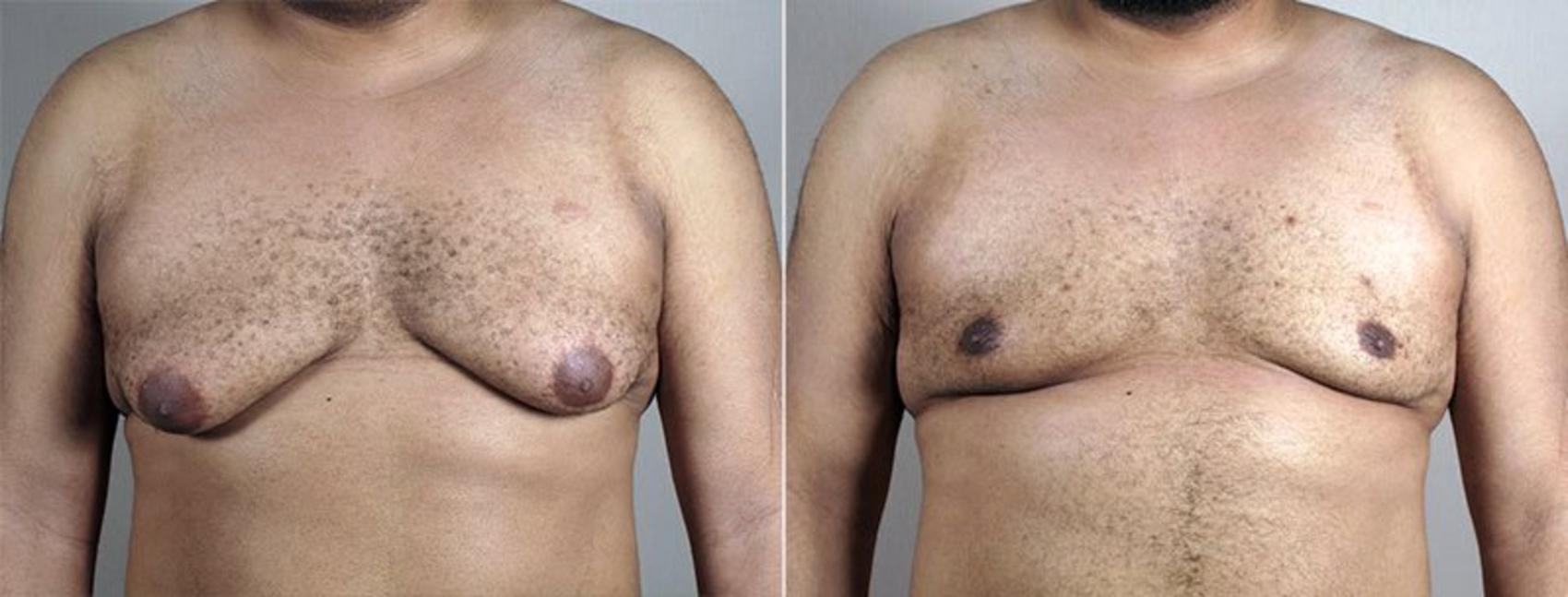 Gynecomastia Surgery Case 671 Before & After View #1 | Paramus, NJ | Parker Center for Plastic Surgery
