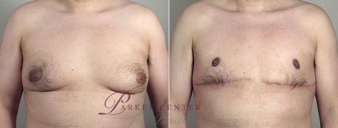 Gynecomastia Surgery Case 675 Before & After View #1 | Paramus, NJ | Parker Center for Plastic Surgery