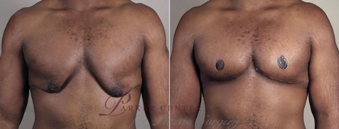 Gynecomastia Surgery Case 676 Before & After View #1 | Paramus, NJ | Parker Center for Plastic Surgery