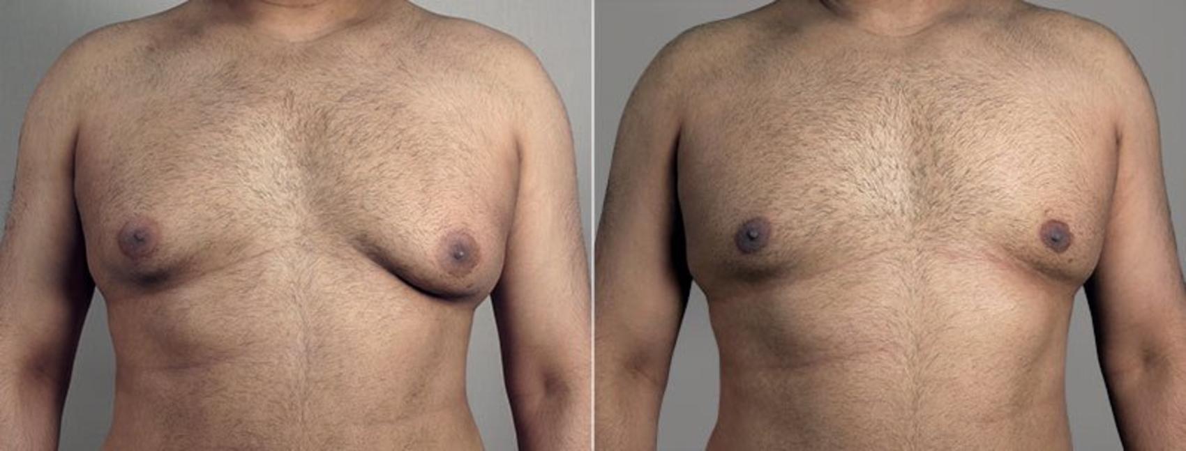 Gynecomastia Surgery Case 679 Before & After View #1 | Paramus, NJ | Parker Center for Plastic Surgery
