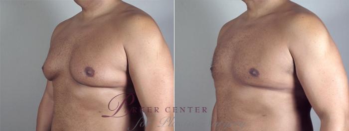 Gynecomastia Surgery Case 943 Before & After View #5 | Paramus, NJ | Parker Center for Plastic Surgery