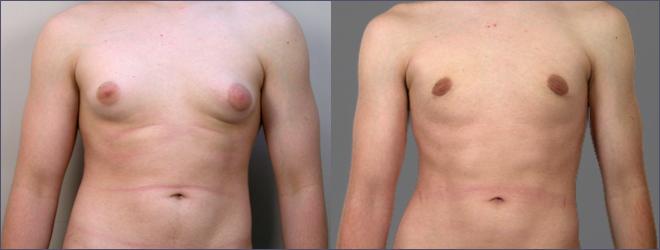 Gynecomastia Surgery Case 613 Before & After View #1 | Paramus, NJ | Parker Center for Plastic Surgery