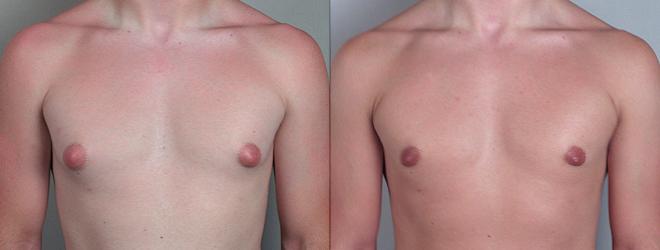 Gynecomastia Surgery Case 618 Before & After View #1 | Paramus, NJ | Parker Center for Plastic Surgery