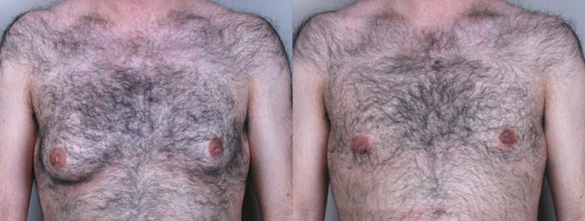 Gynecomastia Surgery Case 619 Before & After View #1 | Paramus, NJ | Parker Center for Plastic Surgery