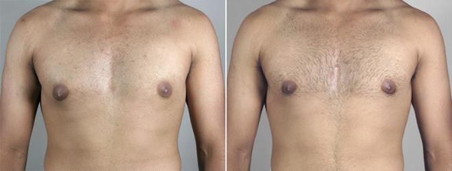 Gynecomastia Surgery Case 625 Before & After View #1 | Paramus, NJ | Parker Center for Plastic Surgery