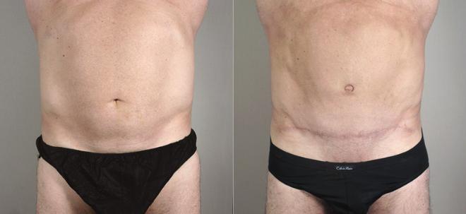 Gynecomastia Surgery Case 641 Before & After View #1 | Paramus, NJ | Parker Center for Plastic Surgery