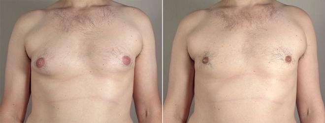 Gynecomastia Surgery Case 648 Before & After View #1 | Paramus, NJ | Parker Center for Plastic Surgery