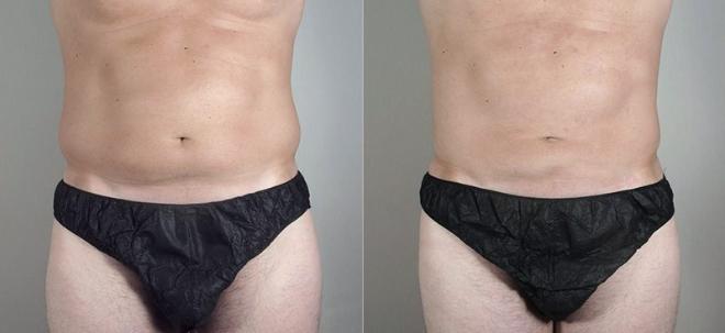 Gynecomastia Surgery Case 649 Before & After View #1 | Paramus, NJ | Parker Center for Plastic Surgery