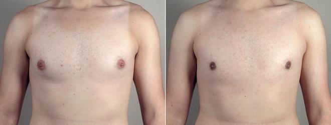 Gynecomastia Surgery Case 672 Before & After View #1 | Paramus, NJ | Parker Center for Plastic Surgery